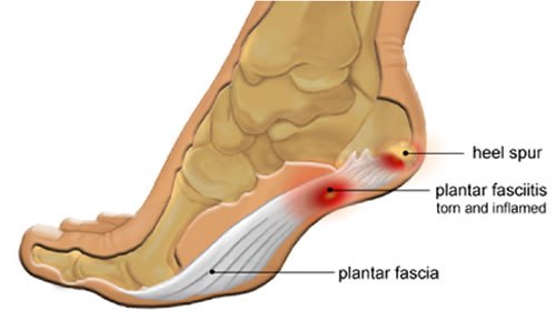 Plantar Fasciitis