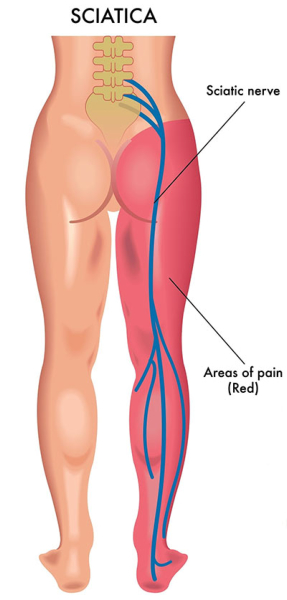 Sciatica