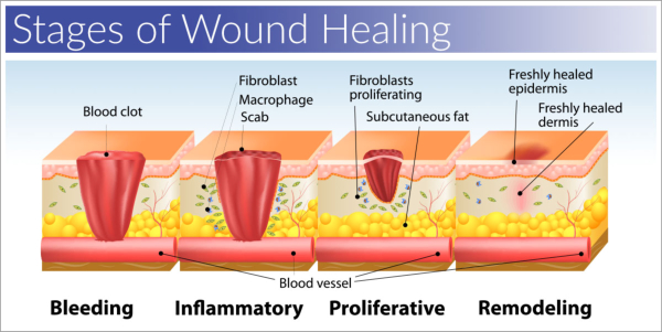 Wound Stages