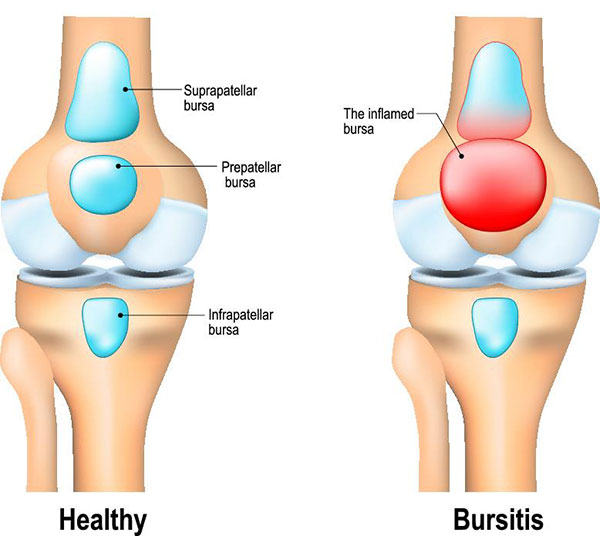 bursitis