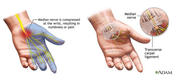 carpal tunnel