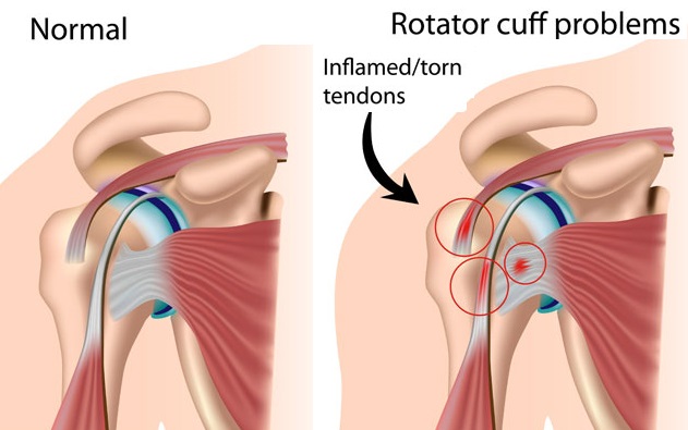 Rotator Cuff