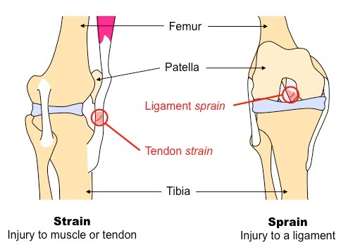 Sprain/Strain