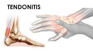 Tendonitis